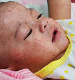 vaccine preventable diseases
